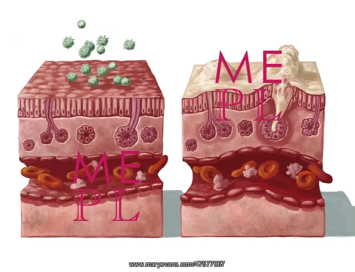: Mucous Reaction to Allergens, Illustration : Mucous Reaction to Allergens, Illustration