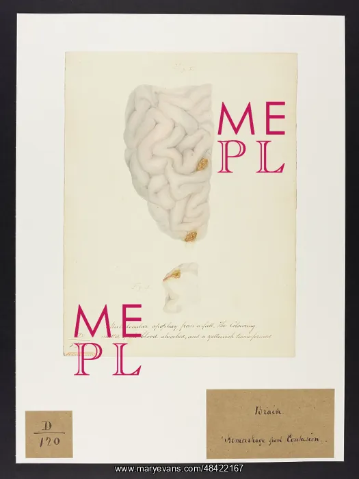 : Multi-locular Apoplexy : Multi-locular Apoplexy