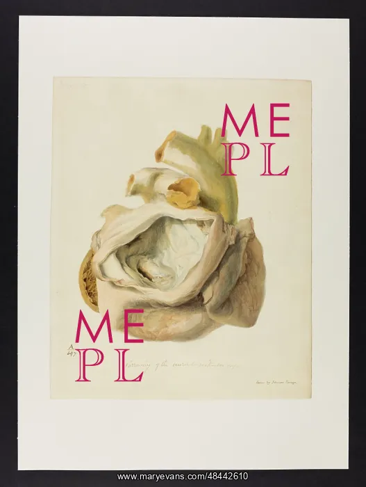 : Narrowing of the Ventriculo-Ventruclar Orifice : Narrowing of the Ventriculo-Ventruclar Orifice