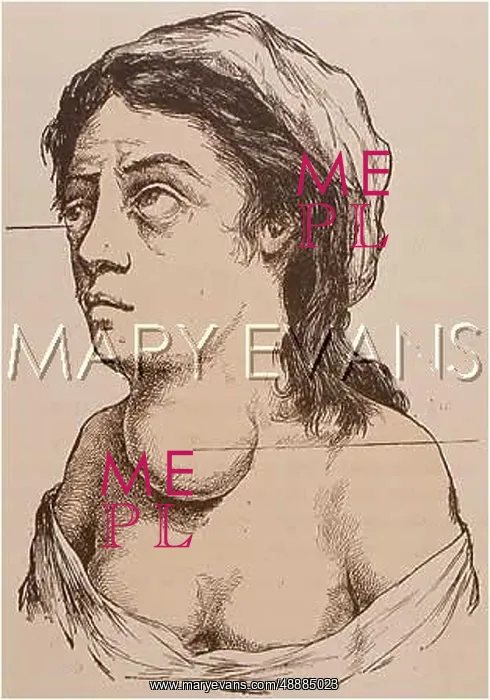 : NECK WELLING / THYROID : NECK WELLING / THYROID