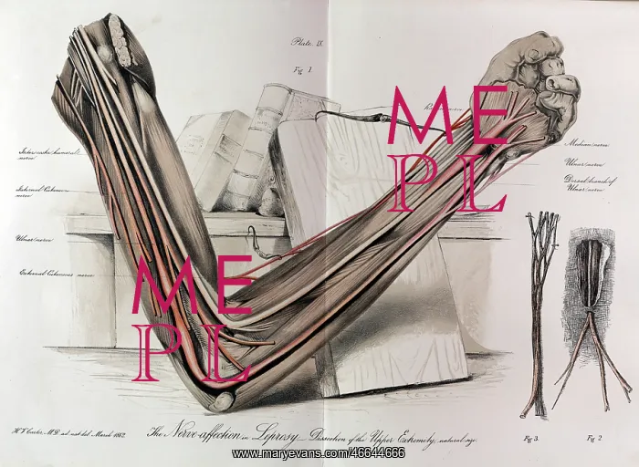: The nerves of the arm in Leprosy : The nerves of the arm in Leprosy
