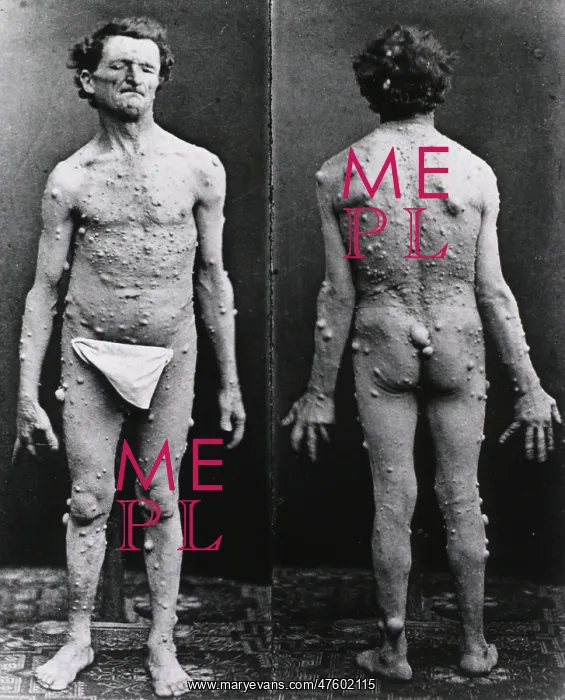 : Neurofibromatosis, 1882 : Neurofibromatosis, 1882