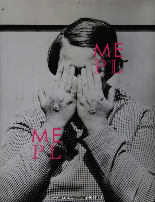 : A new case of stigmata on the hands : A new case of stigmata on the hands