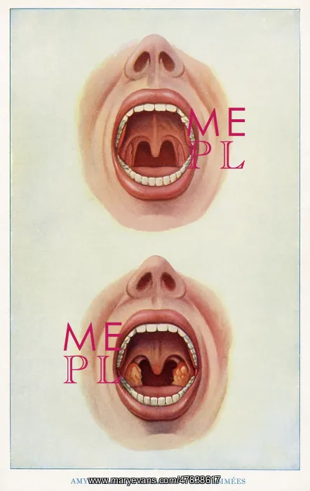 : Normal and inflamed tonsils : Normal and inflamed tonsils