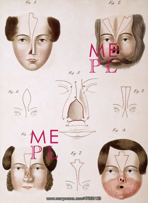 : Nose Reconstruction, 1815 Medical Text : Nose Reconstruction, 1815 Medical Text