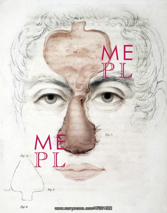 : Nose Reconstruction, 1815 Medical Text : Nose Reconstruction, 1815 Medical Text