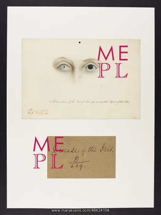 : Obliteration of the Iris and Pupil : Obliteration of the Iris and Pupil