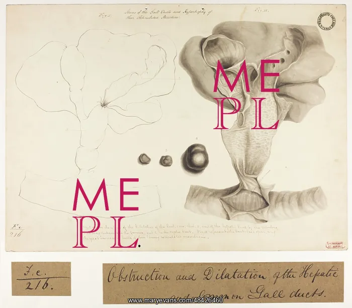 : Obstruction and Dilatation of Hepatic and Common Gall Ducts : Obstruction and Dilatation of Hepatic and Common Gall Ducts