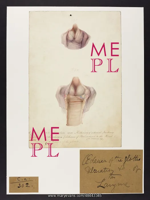 : Oedema of Glottis. Ulceration of larynx : Oedema of Glottis. Ulceration of larynx