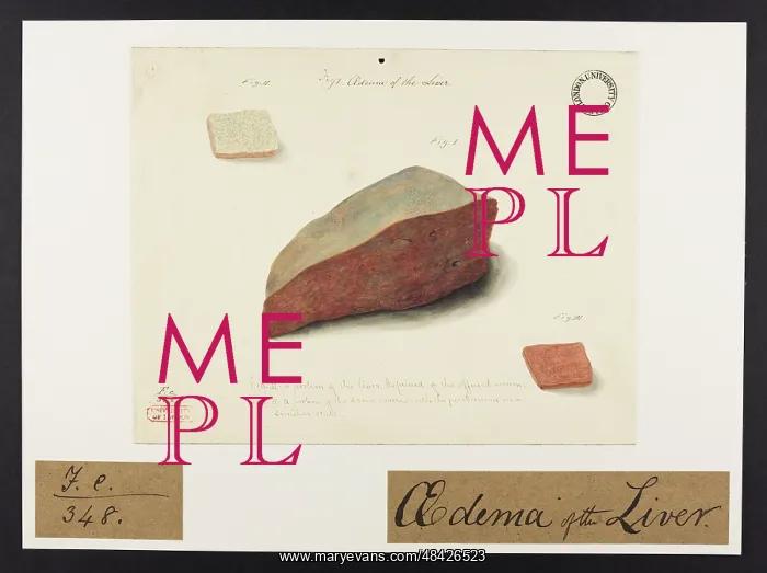 : Oedema of the Liver : Oedema of the Liver