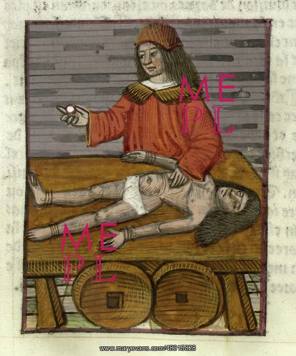 : The operation of the bladder stone : The operation of the bladder stone