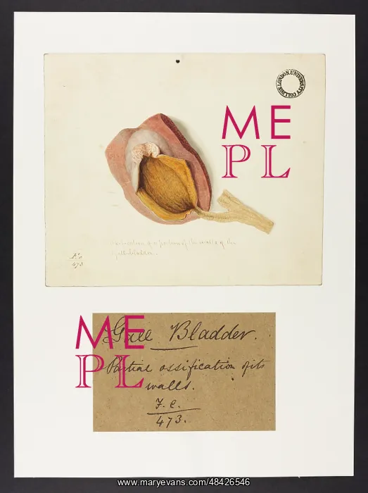 : Ossification of the Gall Bladder : Ossification of the Gall Bladder