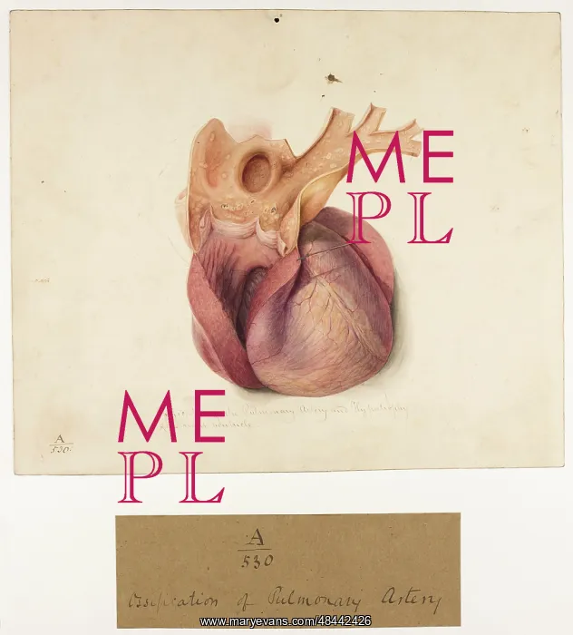 : Ossification of Pulmonary Artery : Ossification of Pulmonary Artery