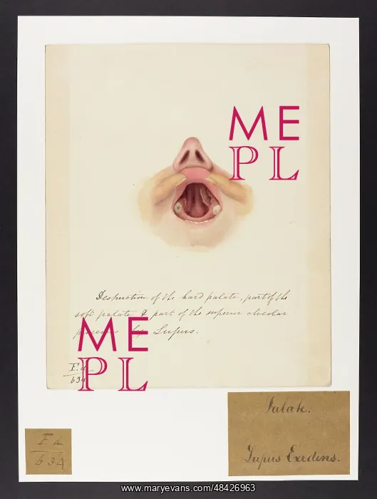 : Palate: Lupus Exedens : Palate: Lupus Exedens