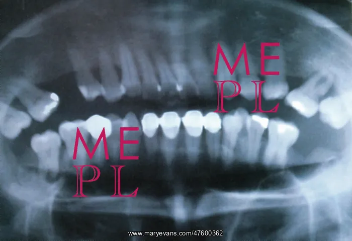 : Panoramic Dental X-Ray : Panoramic Dental X-Ray