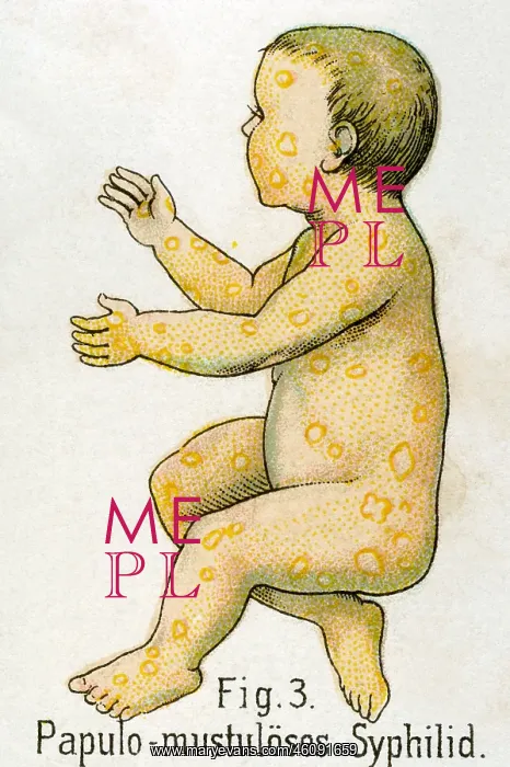 : Papulomustulous syphilis, 1902 : Papulomustulous syphilis, 1902