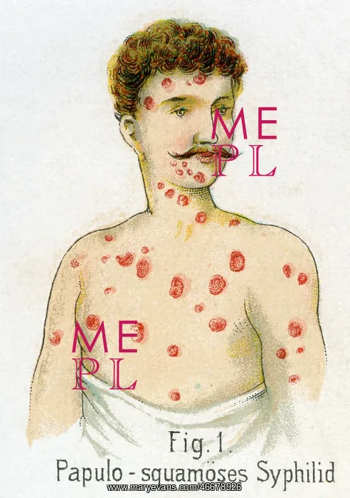  : Papulosquamous syphilis, 1902