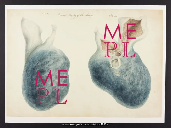 : Partial Atrophy of Lungs : Partial Atrophy of Lungs