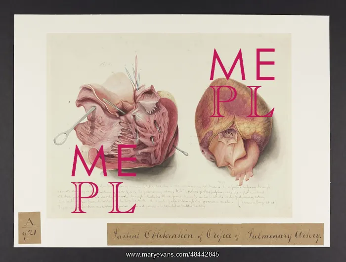 : Partial Obliteration of Orifice of Pulmonary Artery : Partial Obliteration of Orifice of Pulmonary Artery