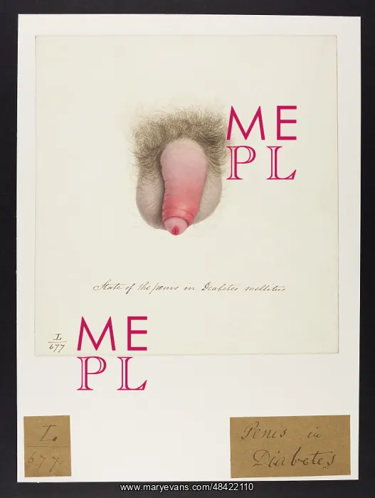 : Penis: Diabetes Mellitus : Penis: Diabetes Mellitus