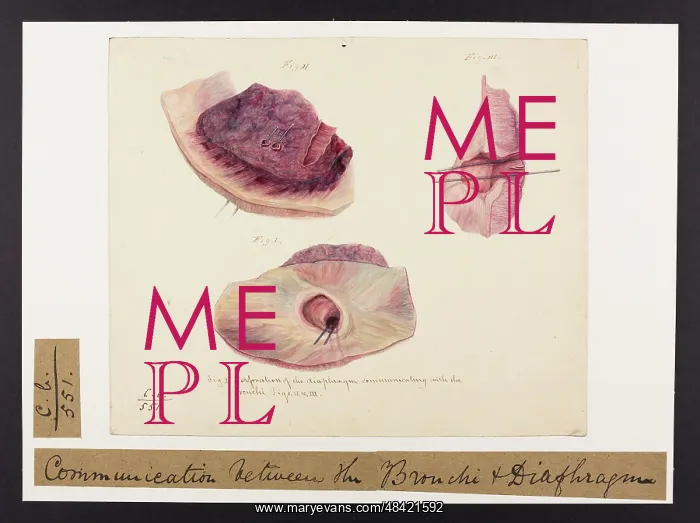 : Perforation of the Diaphragm : Perforation of the Diaphragm
