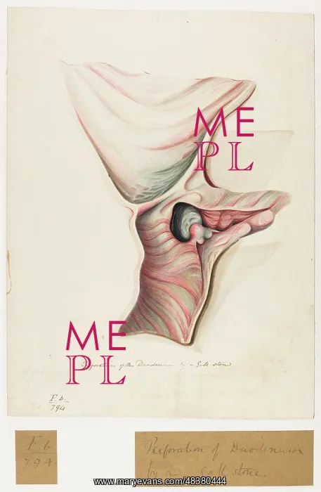 : Perforation of the Duodenum by a Gall Stone : Perforation of the Duodenum by a Gall Stone