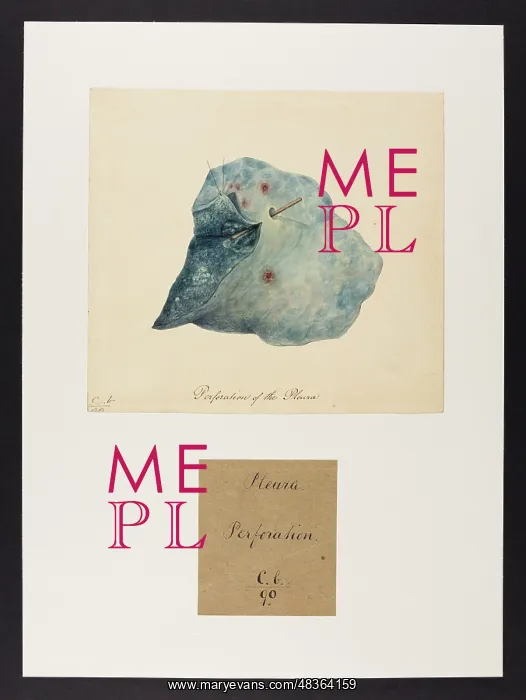 : Perforation of the Pleura : Perforation of the Pleura