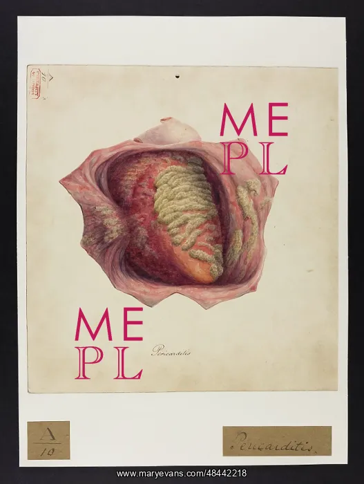 : Pericarditis : Pericarditis
