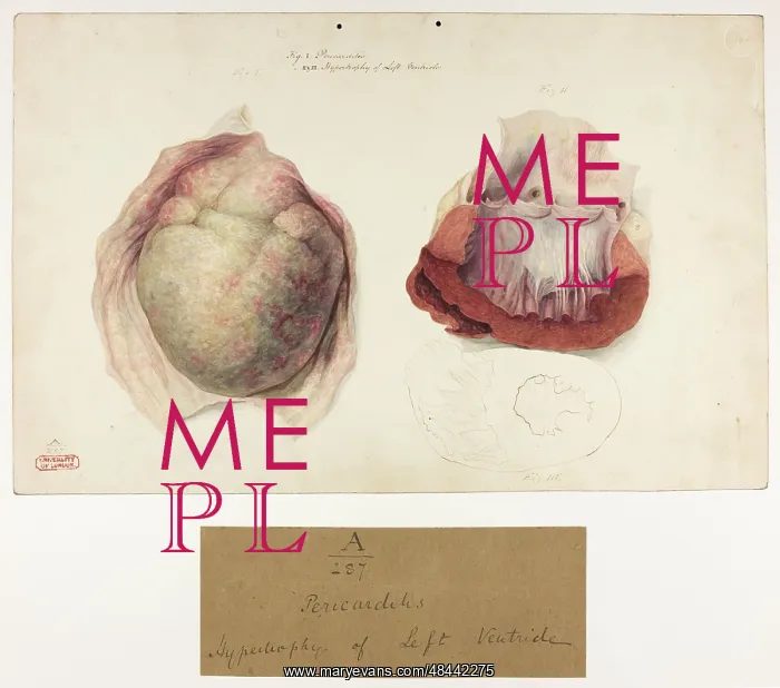 : Pericarditis: Hypertrophy of Left Ventricle : Pericarditis: Hypertrophy of Left Ventricle