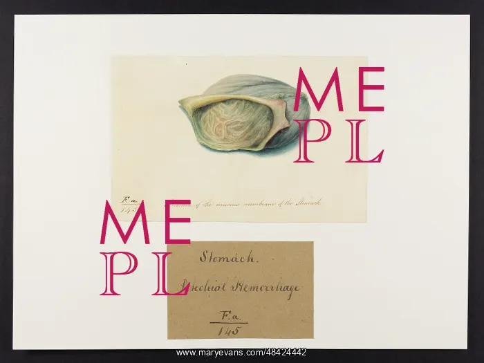 : Petichia of the Mucous Membrane of the Stomach : Petichia of the Mucous Membrane of the Stomach
