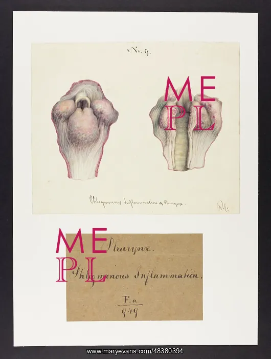 : Pharynx: Phlegmonous Inflammation : Pharynx: Phlegmonous Inflammation