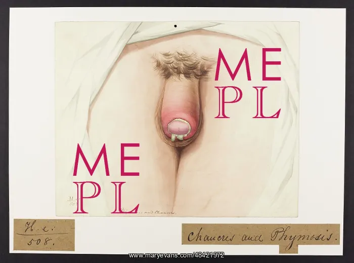 : Phimosis and Chancre : Phimosis and Chancre