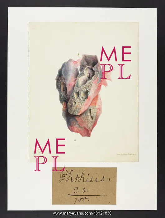 : Phthisis. Drawn by Johnson Savage. Long caption on verso : Phthisis. Drawn by Johnson Savage. Long caption on verso