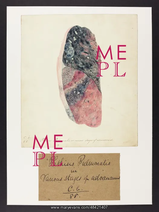 : Phthisis Pulmonalis : Phthisis Pulmonalis