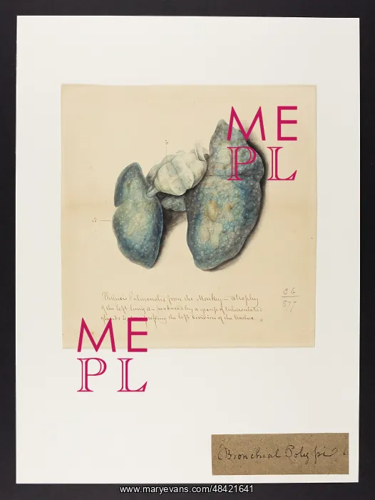 : Phthisis Pulmonalis in a Monkey : Phthisis Pulmonalis in a Monkey