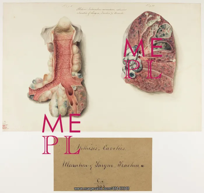 : Phthisis, Tuberculous Excavations, Ulceration of Larynx : Phthisis, Tuberculous Excavations, Ulceration of Larynx