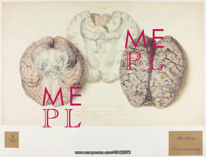 : Pia Mater: Inflammation : Pia Mater: Inflammation