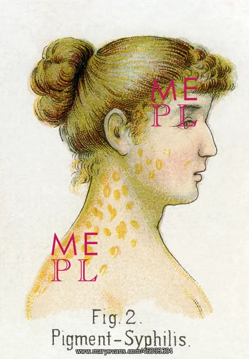 : Pigment syphilis, 1902 : Pigment syphilis, 1902