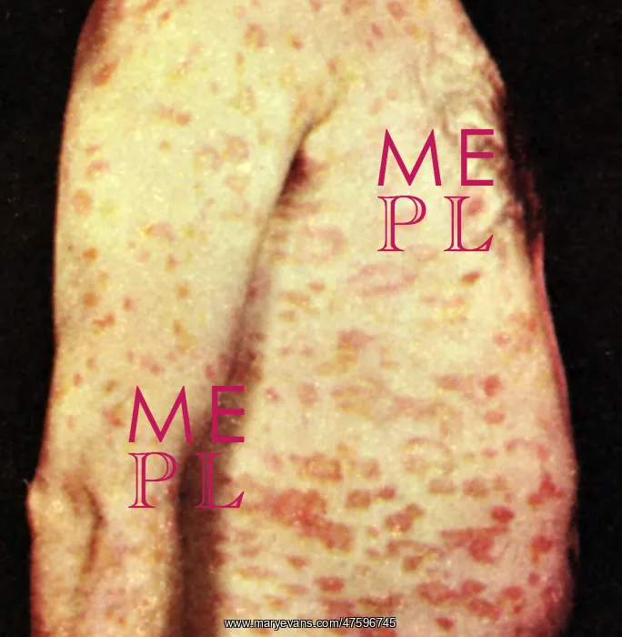 : Pityriasis Rosea : Pityriasis Rosea