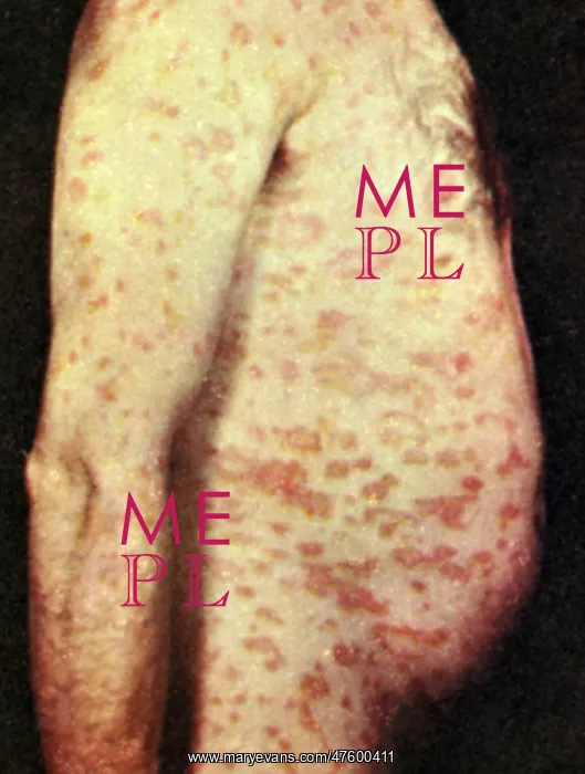 : Pityriasis Rosea : Pityriasis Rosea