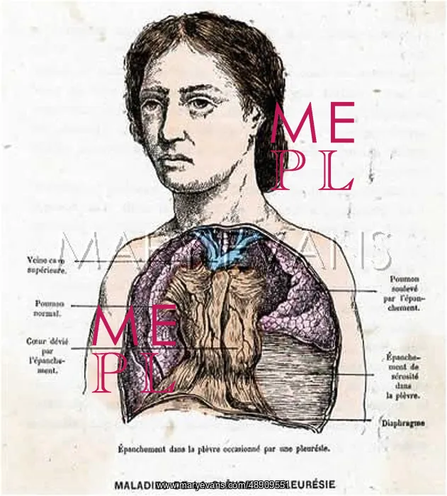 : PLEURISY SUFFERER : PLEURISY SUFFERER