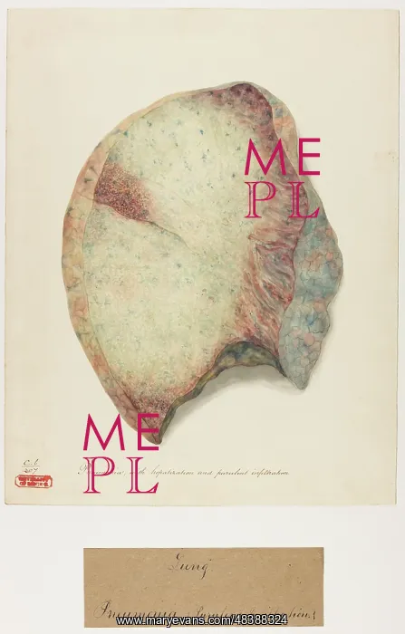 : Pneumonia, with hepatization and purulent infiltration : Pneumonia, with hepatization and purulent infiltration