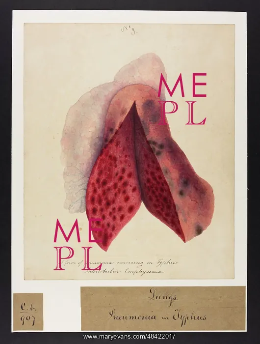 : Pneumonia Occurring in Typhus and Interlobular Emphysema : Pneumonia Occurring in Typhus and Interlobular Emphysema
