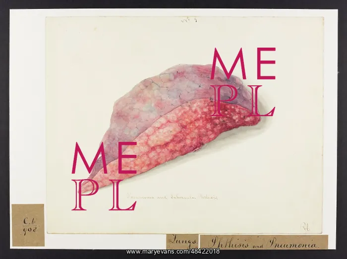 : Pneumonia and Tubercular Phtisis : Pneumonia and Tubercular Phtisis