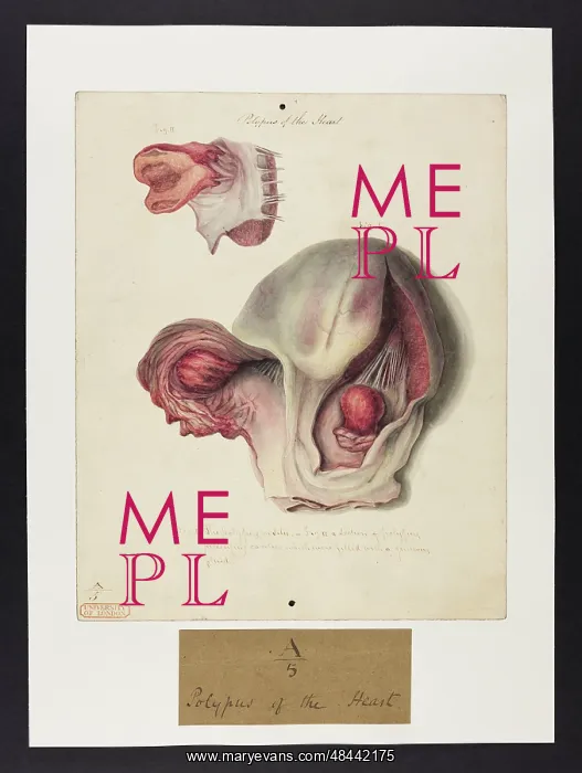 : Polypus of the Heart : Polypus of the Heart