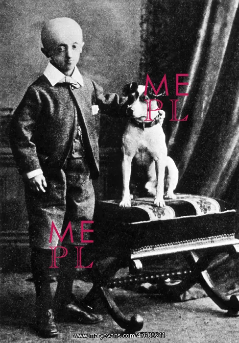 : Progeria, 1911 : Progeria, 1911