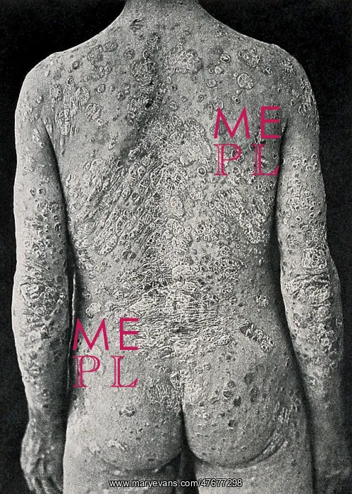 : Psoriasis, Skin Disease : Psoriasis, Skin Disease