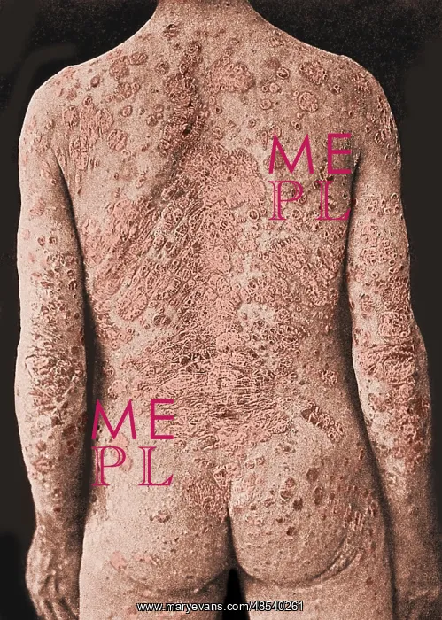 : Psoriasis, Skin Disease : Psoriasis, Skin Disease