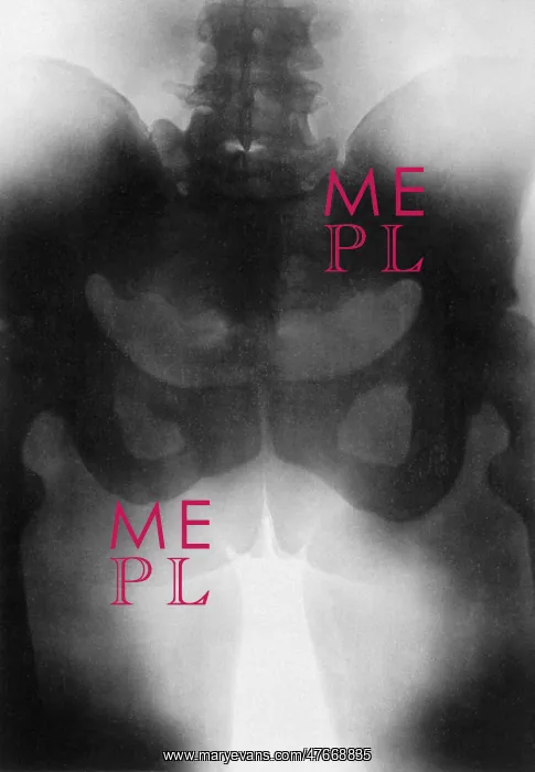  : Pubiotomy, Collotype from X-Ray