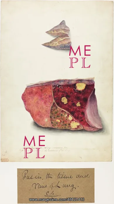 : Pus in the Tissue and Veins of the Lung : Pus in the Tissue and Veins of the Lung